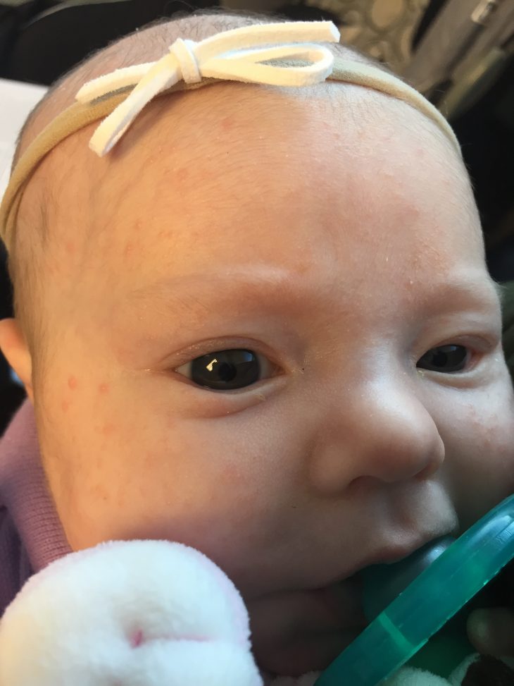 newborn rashes on face cradle cap eczema baby acne