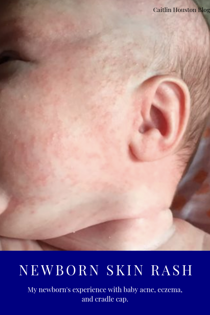 newborn rashes on face cradle cap eczema baby acne
