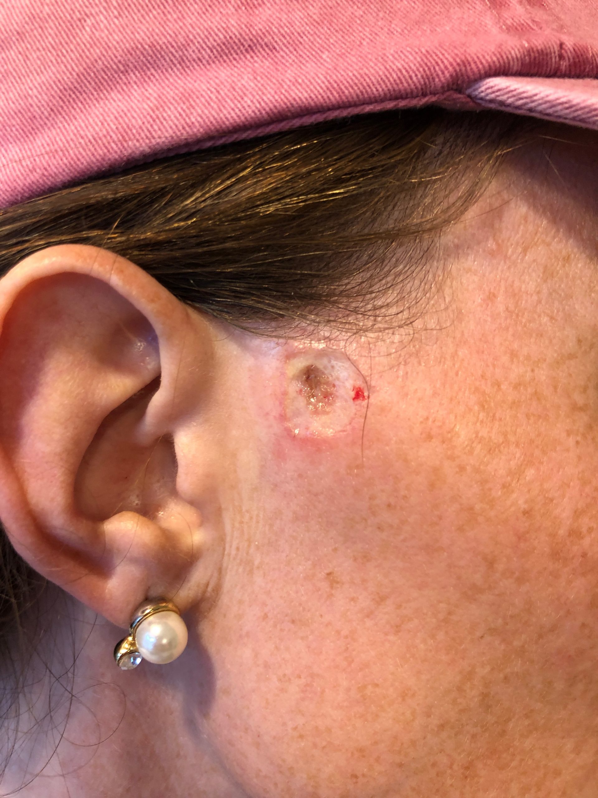 woman after skin cancer biopsy for basal cell carcinoma