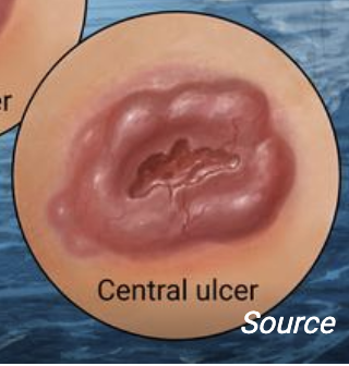 Central Ulcer Skin Cancer